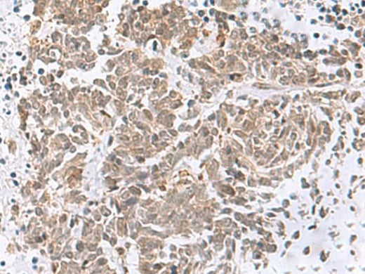 Immunohistochemistry of paraffin-embedded Human lung cancer tissue using RBFOX2 Polyclonal Antibody at dilution of 1:50(×200)
