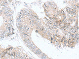 Immunohistochemistry of paraffin-embedded Human colorectal cancer tissue using IQCD Polyclonal Antibody at dilution of 1:90(×200)