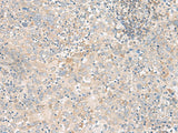Immunohistochemistry of paraffin-embedded Human cervical cancer tissue using FGF13 Polyclonal Antibody at dilution of 1:45(×200)