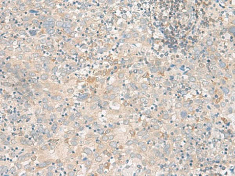 Immunohistochemistry of paraffin-embedded Human cervical cancer tissue using FGF13 Polyclonal Antibody at dilution of 1:45(×200)