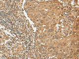Immunohistochemistry of paraffin-embedded Human cervical cancer tissue using TIPRL Polyclonal Antibody at dilution of 1:65(×200)
