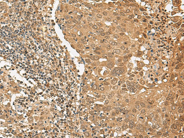 Immunohistochemistry of paraffin-embedded Human cervical cancer tissue using TIPRL Polyclonal Antibody at dilution of 1:65(×200)