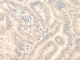 Immunohistochemistry of paraffin-embedded Human thyroid cancer tissue using HMBS Polyclonal Antibody at dilution of 1:25(×200)