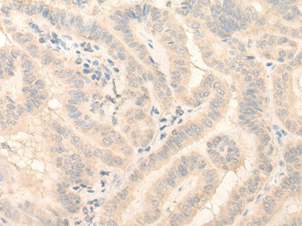 Immunohistochemistry of paraffin-embedded Human thyroid cancer tissue using HMBS Polyclonal Antibody at dilution of 1:25(×200)