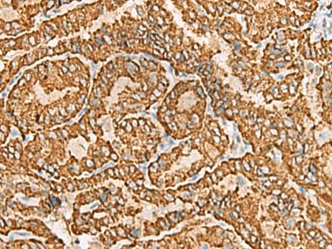 Immunohistochemistry of paraffin-embedded Human thyroid cancer tissue using NPC2 Polyclonal Antibody at dilution of 1:80(×200)