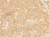 Immunohistochemistry of paraffin-embedded Human ovarian cancer tissue using ST8SIA4 Polyclonal Antibody at dilution of 1:50(×200)
