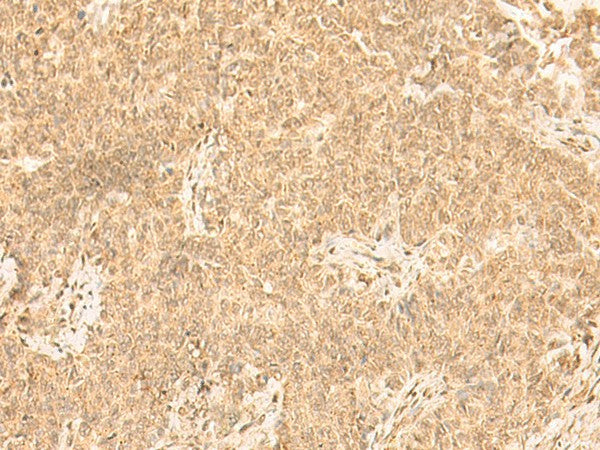 Immunohistochemistry of paraffin-embedded Human ovarian cancer tissue using ST8SIA4 Polyclonal Antibody at dilution of 1:50(×200)