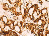 Immunohistochemistry of paraffin-embedded Human thyroid cancer tissue using EPCAM Polyclonal Antibody at dilution of 1:40(×200)