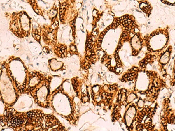 Immunohistochemistry of paraffin-embedded Human thyroid cancer tissue using EPCAM Polyclonal Antibody at dilution of 1:40(×200)