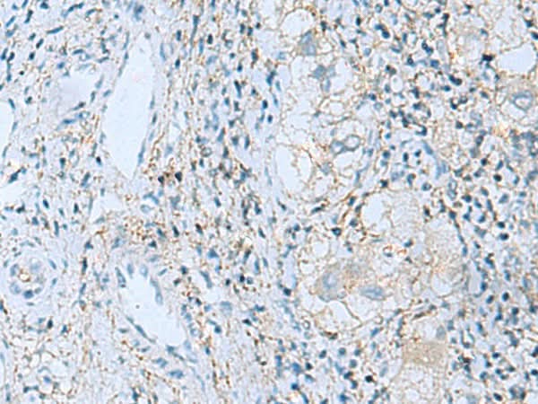 Immunohistochemistry of paraffin-embedded Human liver cancer tissue using EMILIN1 Polyclonal Antibody at dilution of 1:55(×200)