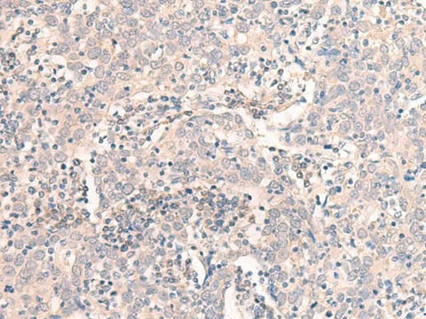 Immunohistochemistry of paraffin-embedded Human cervical cancer tissue using EMX1 Polyclonal Antibody at dilution of 1:25(×200)