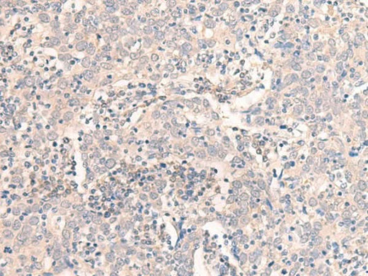 Immunohistochemistry of paraffin-embedded Human cervical cancer tissue using EMX1 Polyclonal Antibody at dilution of 1:25(×200)