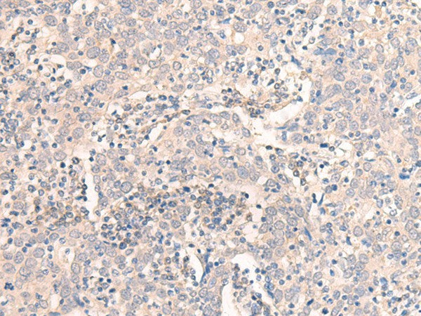 Immunohistochemistry of paraffin-embedded Human cervical cancer tissue using EMX1 Polyclonal Antibody at dilution of 1:25(×200)