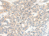 Immunohistochemistry of paraffin-embedded Human liver cancer tissue using CHRD Polyclonal Antibody at dilution of 1:40(×200)