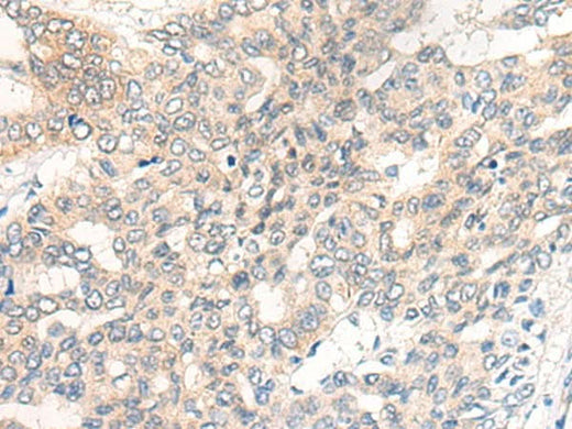 Immunohistochemistry of paraffin-embedded Human liver cancer tissue using CHRD Polyclonal Antibody at dilution of 1:40(×200)