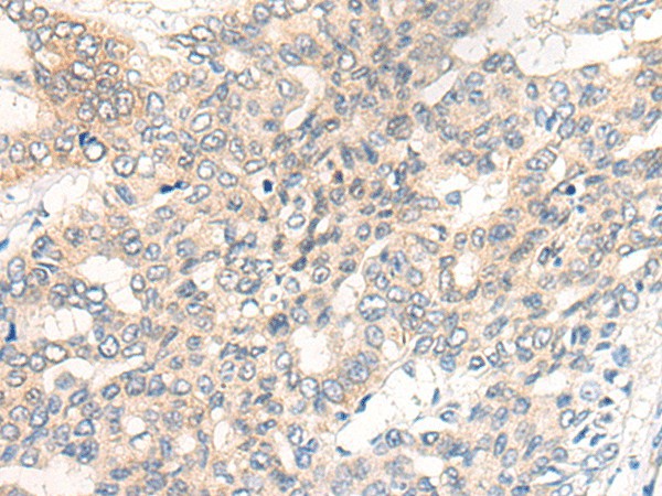 Immunohistochemistry of paraffin-embedded Human liver cancer tissue using CHRD Polyclonal Antibody at dilution of 1:40(×200)