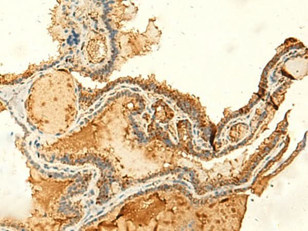 Immunohistochemistry of paraffin-embedded Human thyroid cancer tissue using KIAA0513 Polyclonal Antibody at dilution of 1:50(×200)