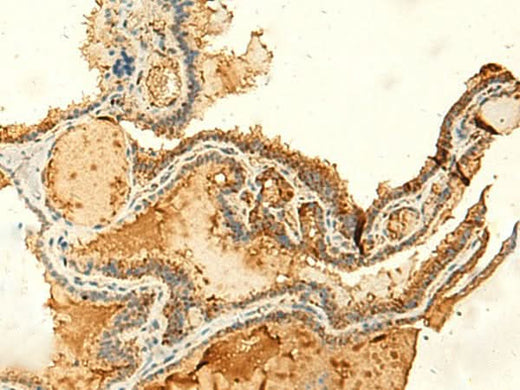 Immunohistochemistry of paraffin-embedded Human thyroid cancer tissue using KIAA0513 Polyclonal Antibody at dilution of 1:50(×200)