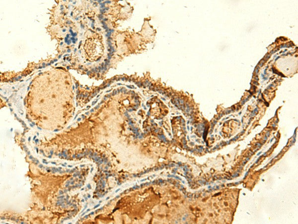 Immunohistochemistry of paraffin-embedded Human thyroid cancer tissue using KIAA0513 Polyclonal Antibody at dilution of 1:50(×200)