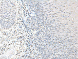 Immunohistochemistry of paraffin-embedded Human esophagus cancer tissue using EPM2A Polyclonal Antibody at dilution of 1:55(×200)