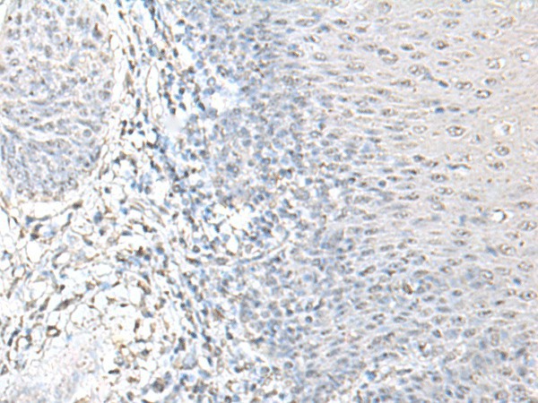 Immunohistochemistry of paraffin-embedded Human esophagus cancer tissue using EPM2A Polyclonal Antibody at dilution of 1:55(×200)