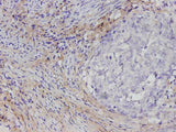 Immunohistochemistry of paraffin-embedded Human cervical cancer tissue using COL1A1 Polyclonal Antibody at dilution of 1:1700(×400)