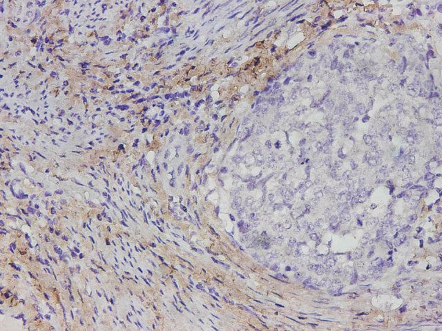 Immunohistochemistry of paraffin-embedded Human cervical cancer tissue using COL1A1 Polyclonal Antibody at dilution of 1:1700(×400)