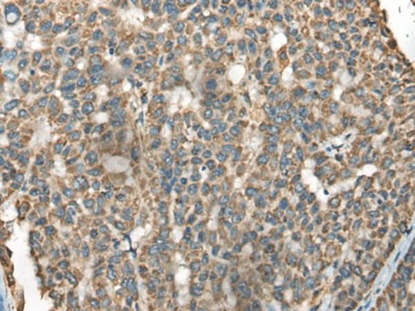 Immunohistochemistry of paraffin-embedded Human liver cancer tissue using BLNK Polyclonal Antibody at dilution of 1:65(×200)