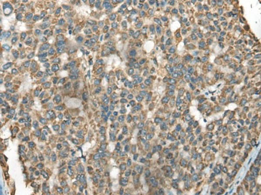 Immunohistochemistry of paraffin-embedded Human liver cancer tissue using BLNK Polyclonal Antibody at dilution of 1:65(×200)