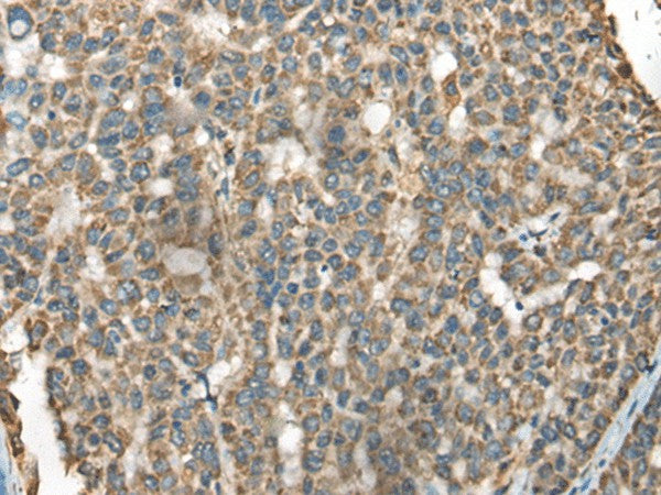 Immunohistochemistry of paraffin-embedded Human liver cancer tissue using BLNK Polyclonal Antibody at dilution of 1:65(×200)