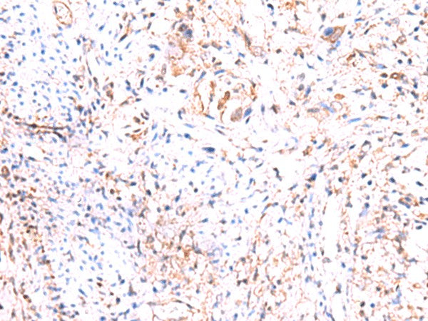 Immunohistochemistry of paraffin-embedded Human cervical cancer tissue using PHKG2 Polyclonal Antibody at dilution of 1:60(×200)