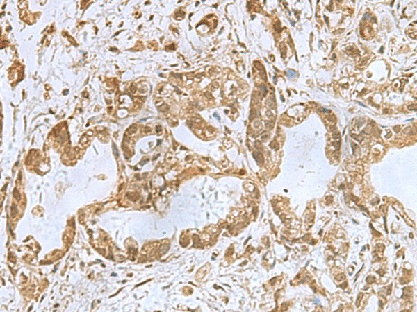 Immunohistochemistry of paraffin-embedded Human gastric cancer tissue using PHF6 Polyclonal Antibody at dilution of 1:85(×200)