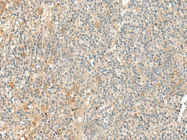 Immunohistochemistry of paraffin-embedded Human tonsil tissue using NGEF Polyclonal Antibody at dilution of 1:35(×200)
