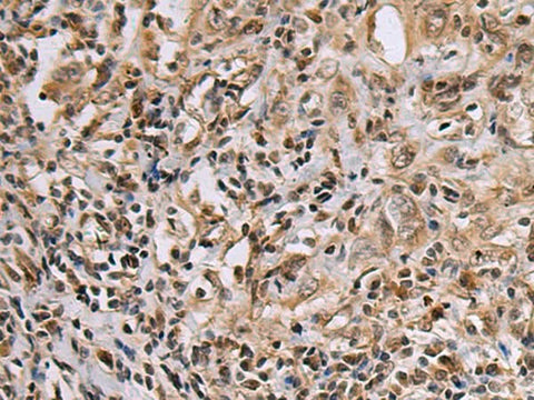Immunohistochemistry of paraffin-embedded Human esophagus cancer tissue using DNA2 Polyclonal Antibody at dilution of 1:60(×200)