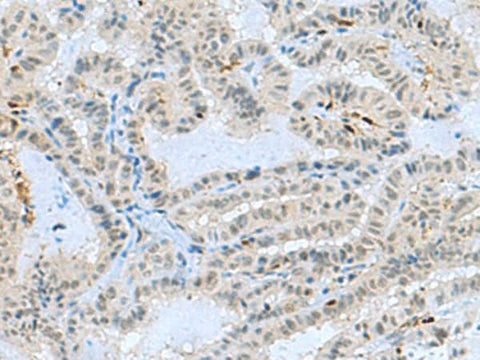 Immunohistochemistry of paraffin-embedded Human thyroid cancer tissue using TCF19 Polyclonal Antibody at dilution of 1:60(×200)