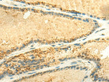 Immunohistochemistry of paraffin-embedded Human thyroid cancer tissue using EEF1AKMT2 Polyclonal Antibody at dilution of 1:50(×200)