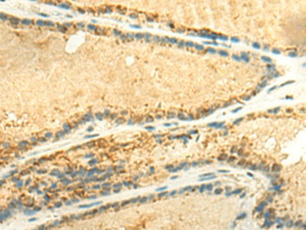 Immunohistochemistry of paraffin-embedded Human thyroid cancer tissue using EEF1AKMT2 Polyclonal Antibody at dilution of 1:50(×200)