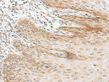 Immunohistochemistry of paraffin-embedded Human esophagus cancer tissue using RALGAPA1 Polyclonal Antibody at dilution of 1:55(×200)