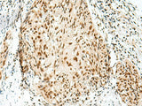 Immunohistochemistry of paraffin-embedded Human esophagus cancer tissue using RBM10 Polyclonal Antibody at dilution of 1:55(×200)