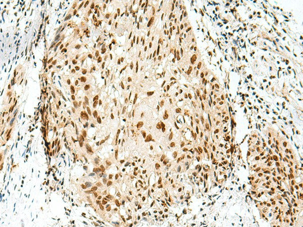 Immunohistochemistry of paraffin-embedded Human esophagus cancer tissue using RBM10 Polyclonal Antibody at dilution of 1:55(×200)