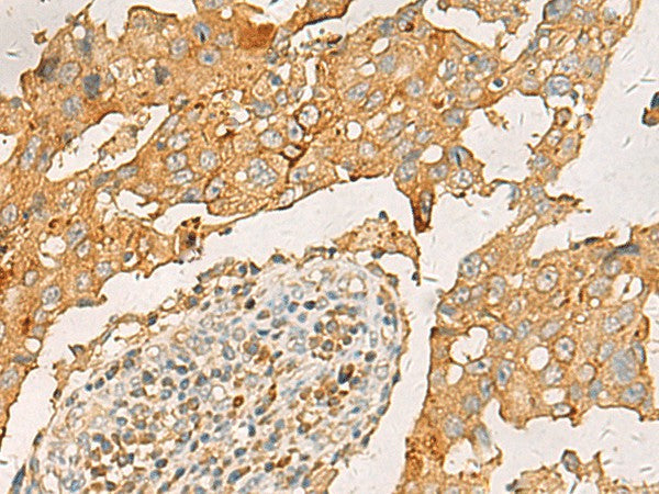Immunohistochemistry of paraffin-embedded Human breast cancer tissue using CXCL1 Polyclonal Antibody at dilution of 1:35(×200)