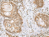 Immunohistochemistry of paraffin-embedded Human esophagus cancer tissue using ELAC1 Polyclonal Antibody at dilution of 1:65(×200)