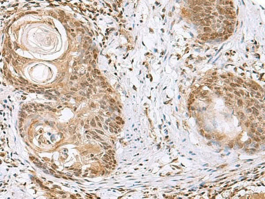 Immunohistochemistry of paraffin-embedded Human esophagus cancer tissue using ELAC1 Polyclonal Antibody at dilution of 1:65(×200)