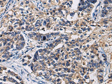 Immunohistochemistry of paraffin-embedded Human gastric cancer tissue using SSH3 Polyclonal Antibody at dilution of 1:55(×200)