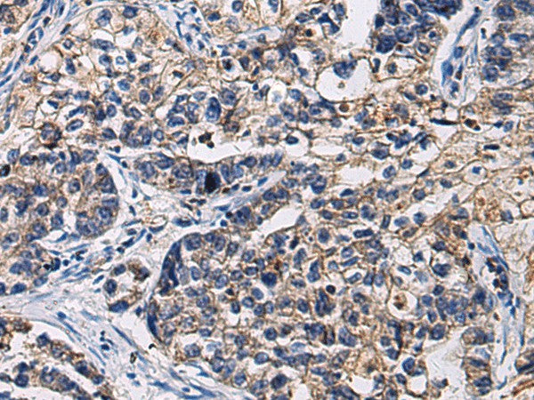 Immunohistochemistry of paraffin-embedded Human gastric cancer tissue using SSH3 Polyclonal Antibody at dilution of 1:55(×200)