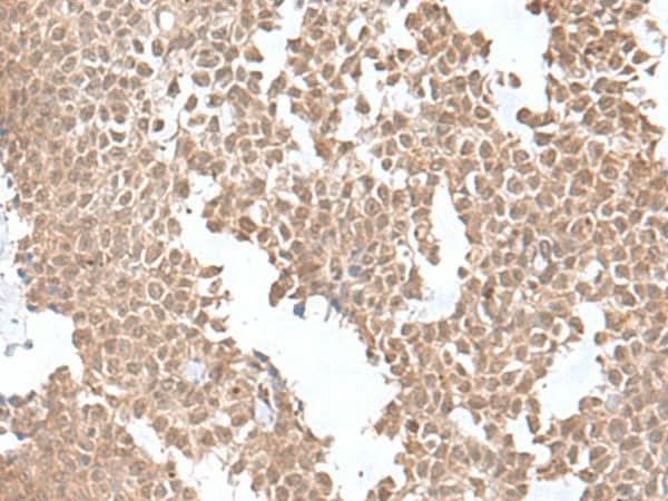 Immunohistochemistry of paraffin-embedded Human ovarian cancer tissue using SNRNP25 Polyclonal Antibody at dilution of 1:55(×200)