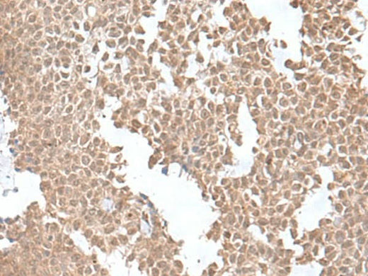 Immunohistochemistry of paraffin-embedded Human ovarian cancer tissue using SNRNP25 Polyclonal Antibody at dilution of 1:55(×200)