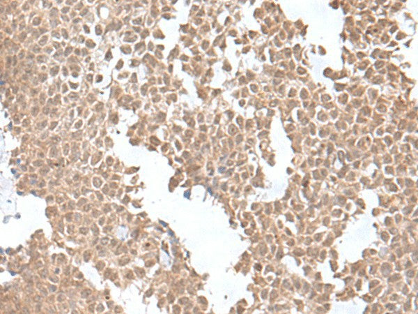 Immunohistochemistry of paraffin-embedded Human ovarian cancer tissue using SNRNP25 Polyclonal Antibody at dilution of 1:55(×200)