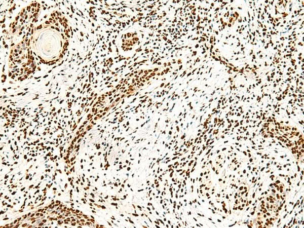 Immunohistochemistry of paraffin-embedded Human esophagus cancer tissue using ILF3 Polyclonal Antibody at dilution of 1:40(×200)