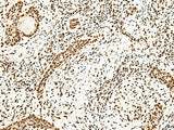 Immunohistochemistry of paraffin-embedded Human esophagus cancer tissue using ILF3 Polyclonal Antibody at dilution of 1:40(×200)